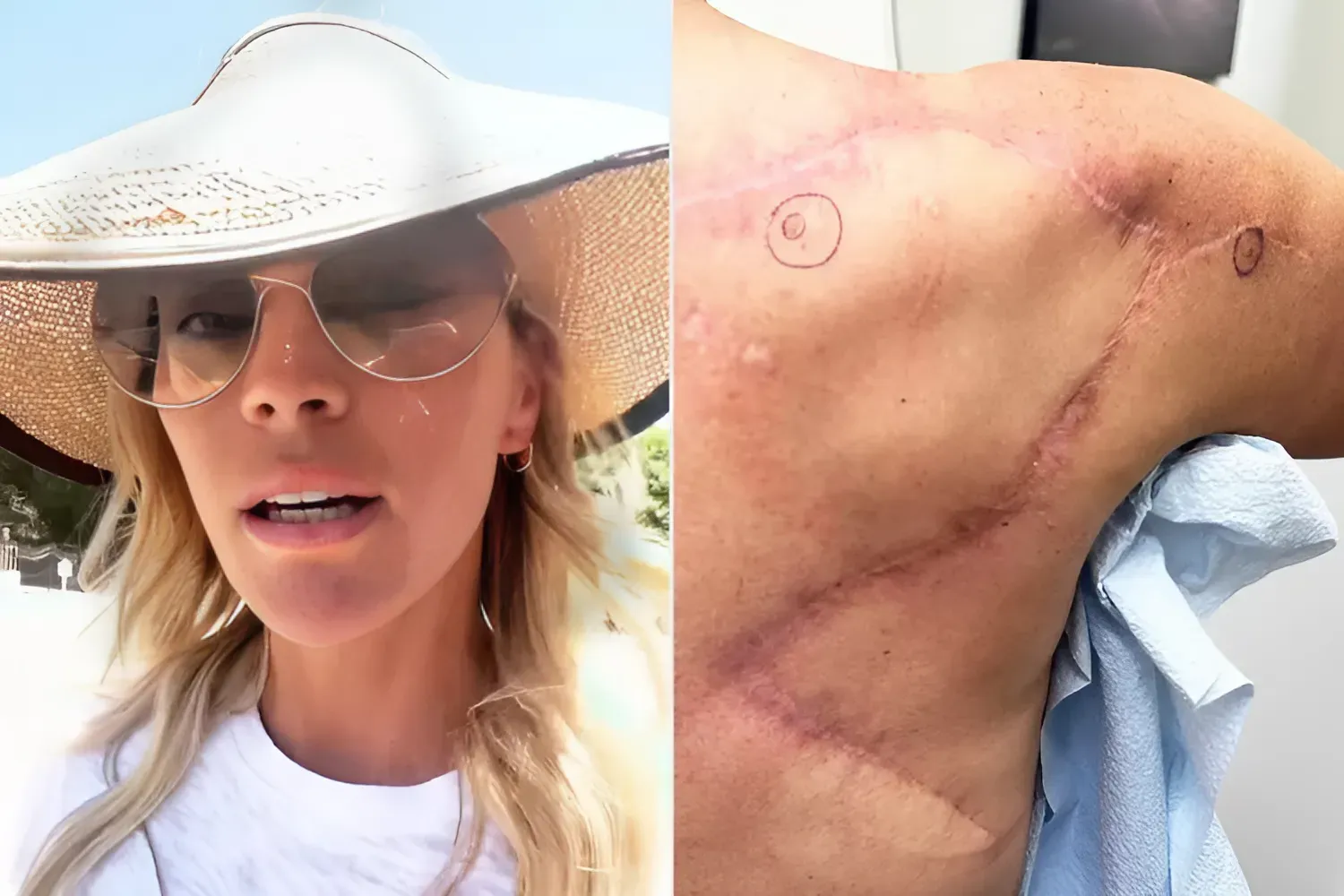 Teddi Mellencamp Gets '2 More Removed' in Ongoing Melanoma Struggle: 'Anxiety Is Pretty High'