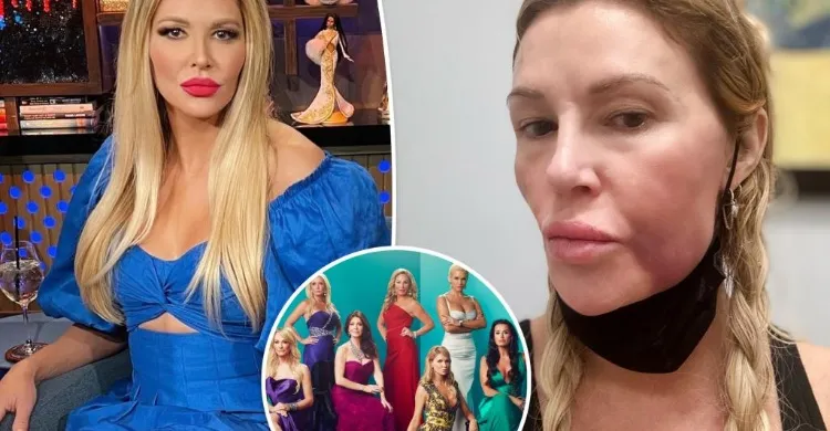 ‘Miserable’ Brandi Glanville blames Bravo for severe facial swelling: ‘Stress will kill you’