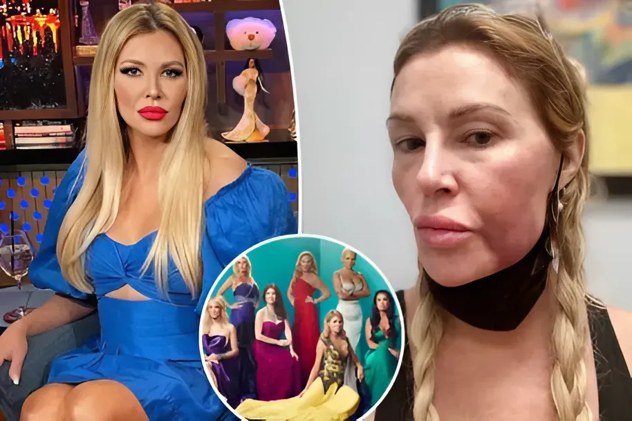 ‘Miserable’ Brandi Glanville blames Bravo for severe facial swelling: ‘Stress will kill you’