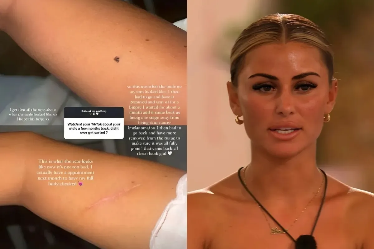 Love Island star shares update on terrifying cancer scare just weeks after leaving the villa ngocc