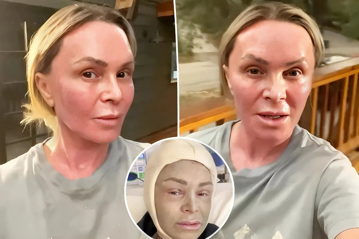 Tamra Judge shares update on ‘sanded and revarnished’ face after plastic surgery: ‘The worst of it is over’