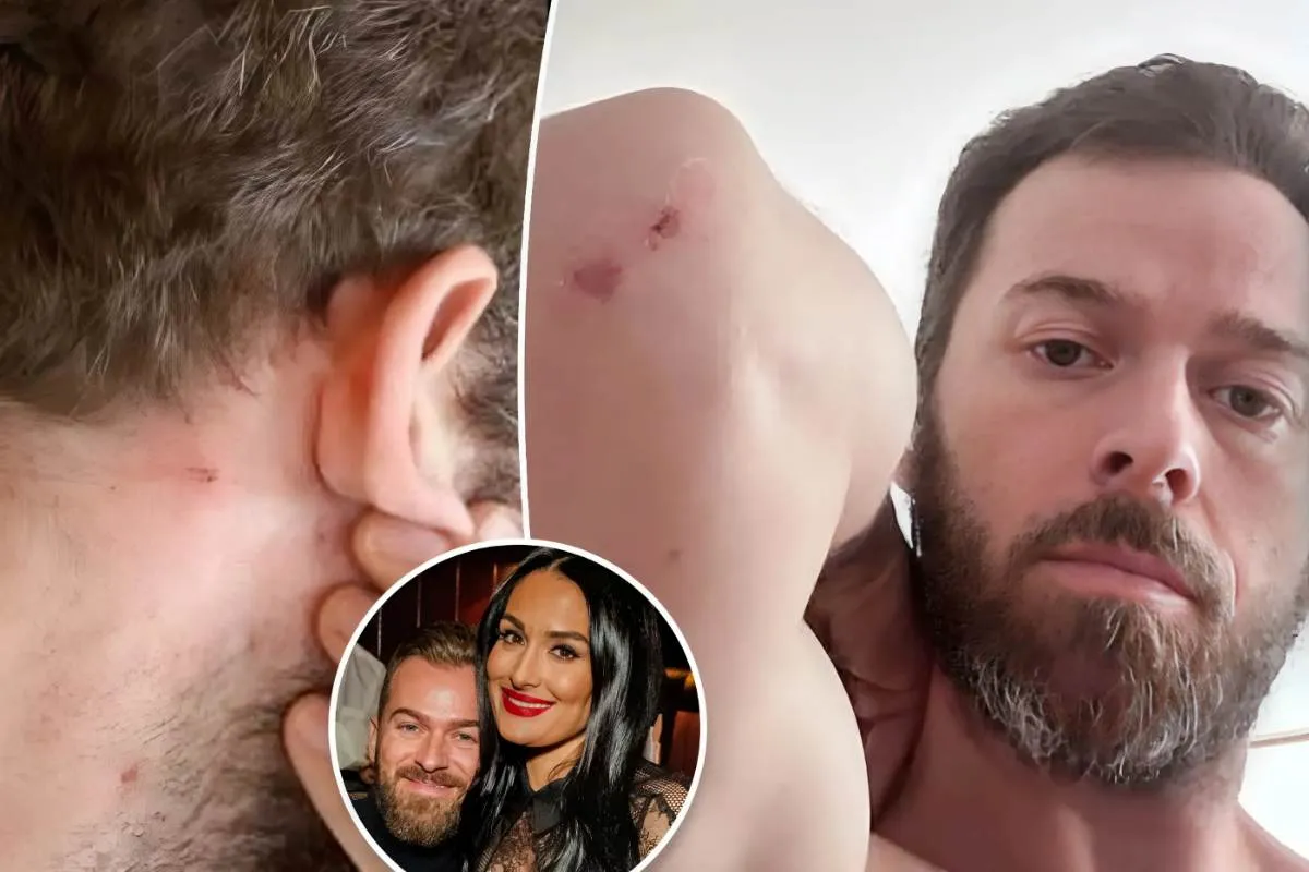 Artem Chigvintsev claims estranged wife Nikki Garcia was the abuser, shows off bloody scratches on arms, neck tram