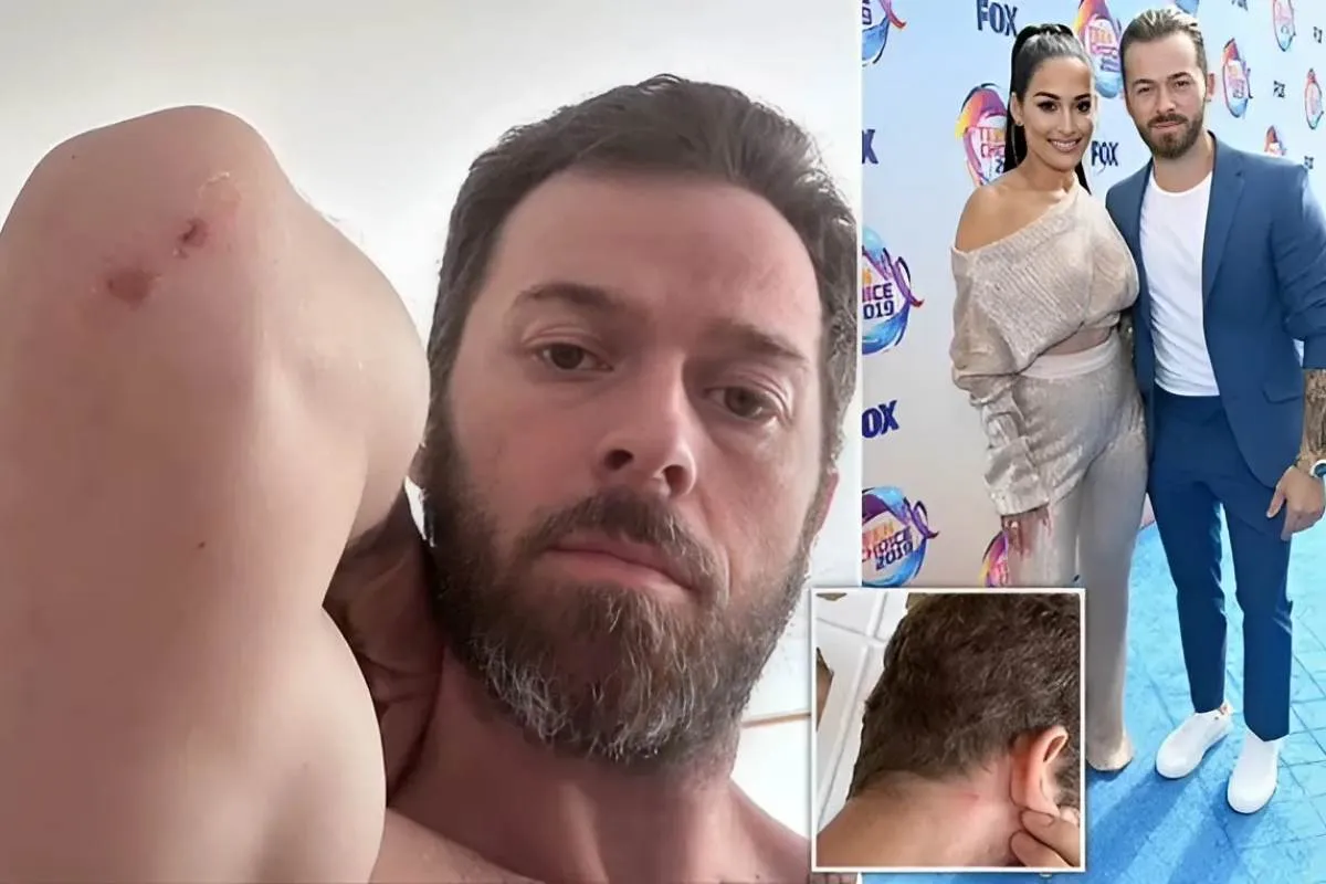 Artem Chigvintsev shares photos of 'injuries' as he accuses estranged wife Nikki Garcia as being the real abuser tram