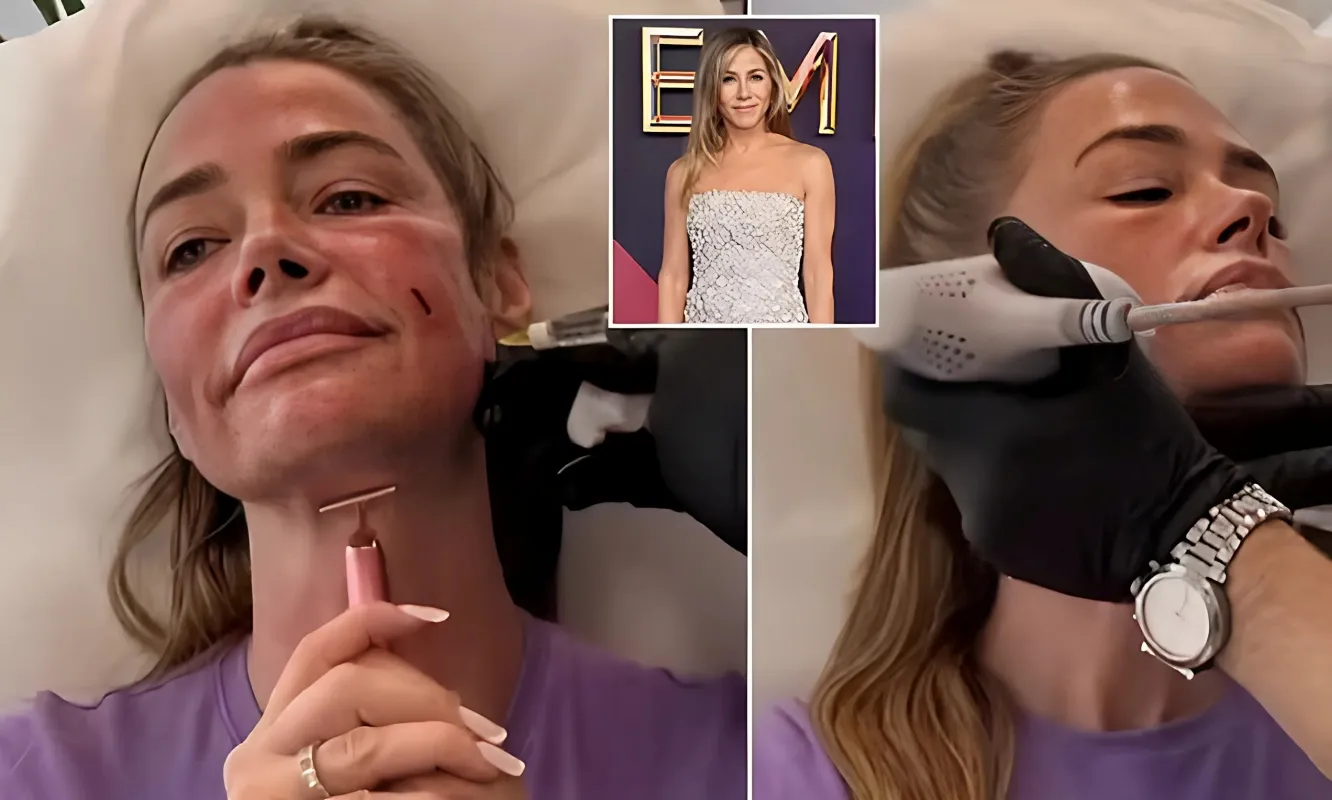 Denise Richards, 53, gets painful-looking $2K salmon DNA treatment after Jennifer Aniston talked it upp