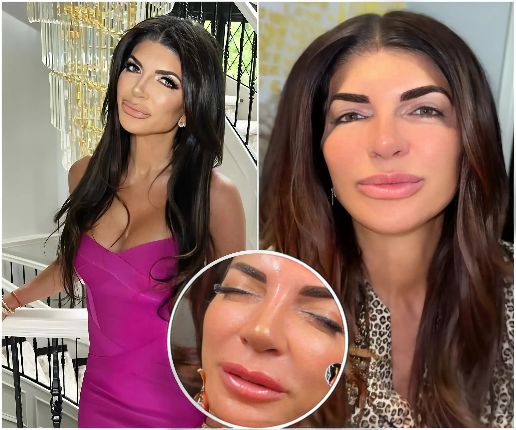 RHONJ’s Teresa Giudice Got Her “Hot Dog” Lips Dissolved