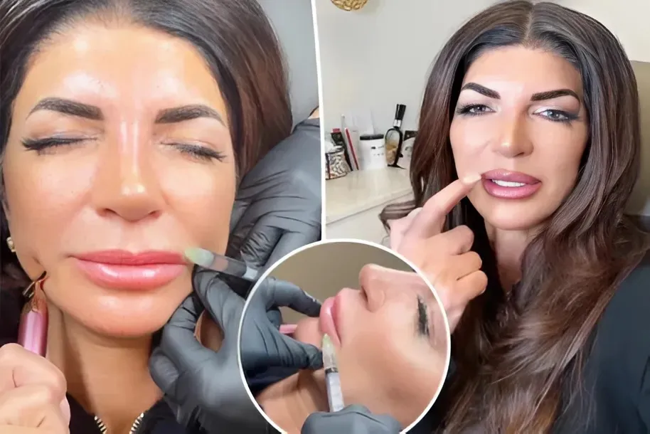 Teresa Giudice reveals she is dissolving her lip filler after backlash over her appearance