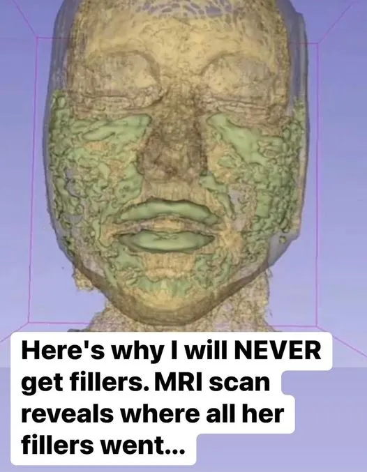 Doctor Reveals: MRI Scan Of The Face Of A 33-Year-Old Woman Reveals Where All Of Her Filler Went