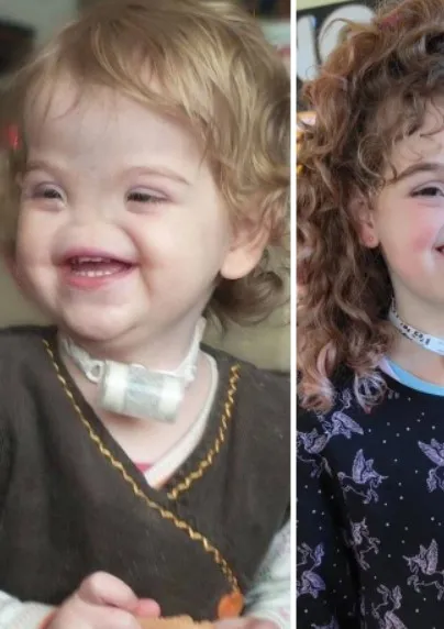 Meet a Girl Born Without a Nose: Some Call Her “Voldemort”, But In Reality She Is a Very Sweet Girl!