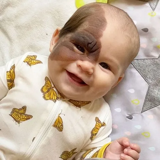 A Mother’s Love: The Journey to Remove Vienna’s Birthmark and Secure Her Future