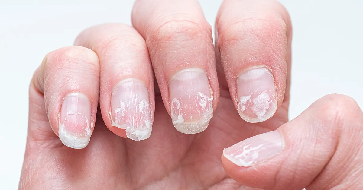 5. Rippled fingernails reveal secrets of possible disease S2