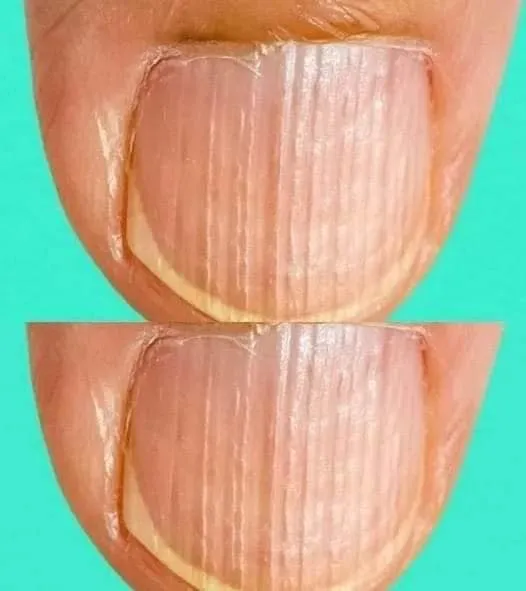 5. Rippled fingernails reveal secrets of possible disease s3