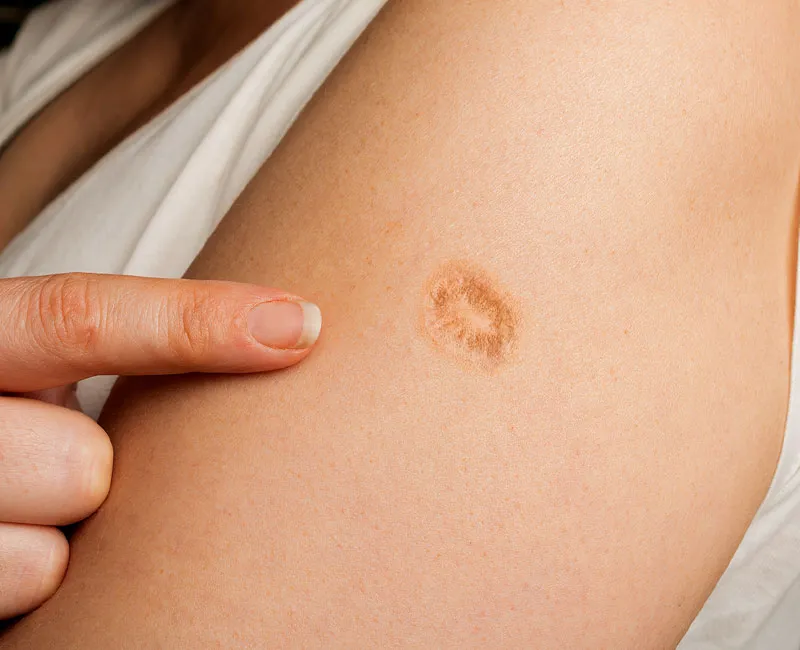 P1. Smallpox vaccine scars: What they look like and why