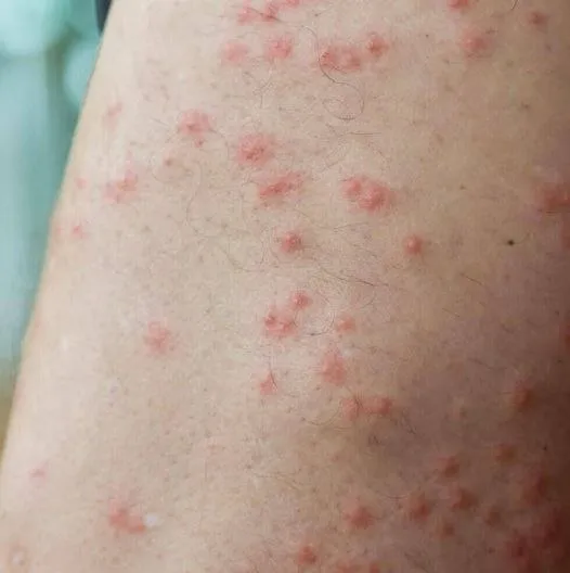 How To Identify 10 Of The Most Common Bug Bites