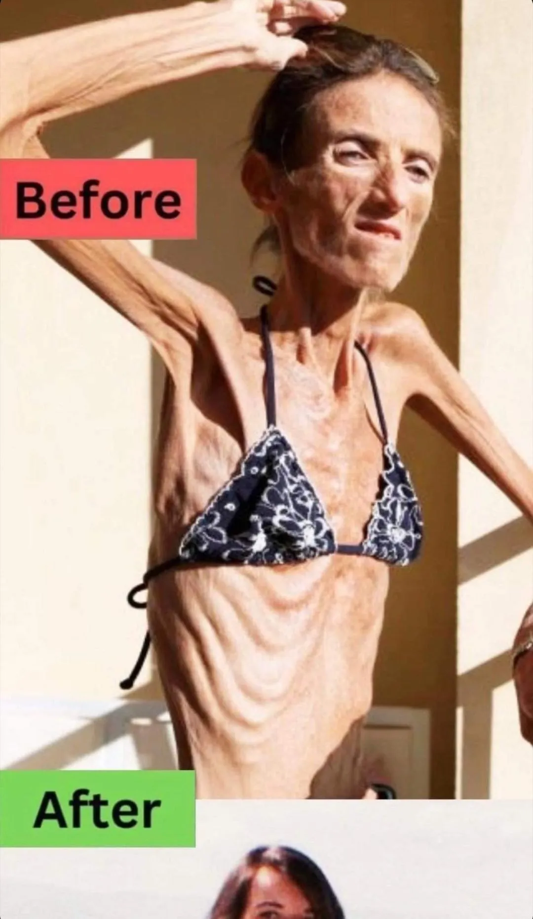 5.. The World’s Thinnest Woman’s Battle Against Anorexia Will Leave You Speechless!