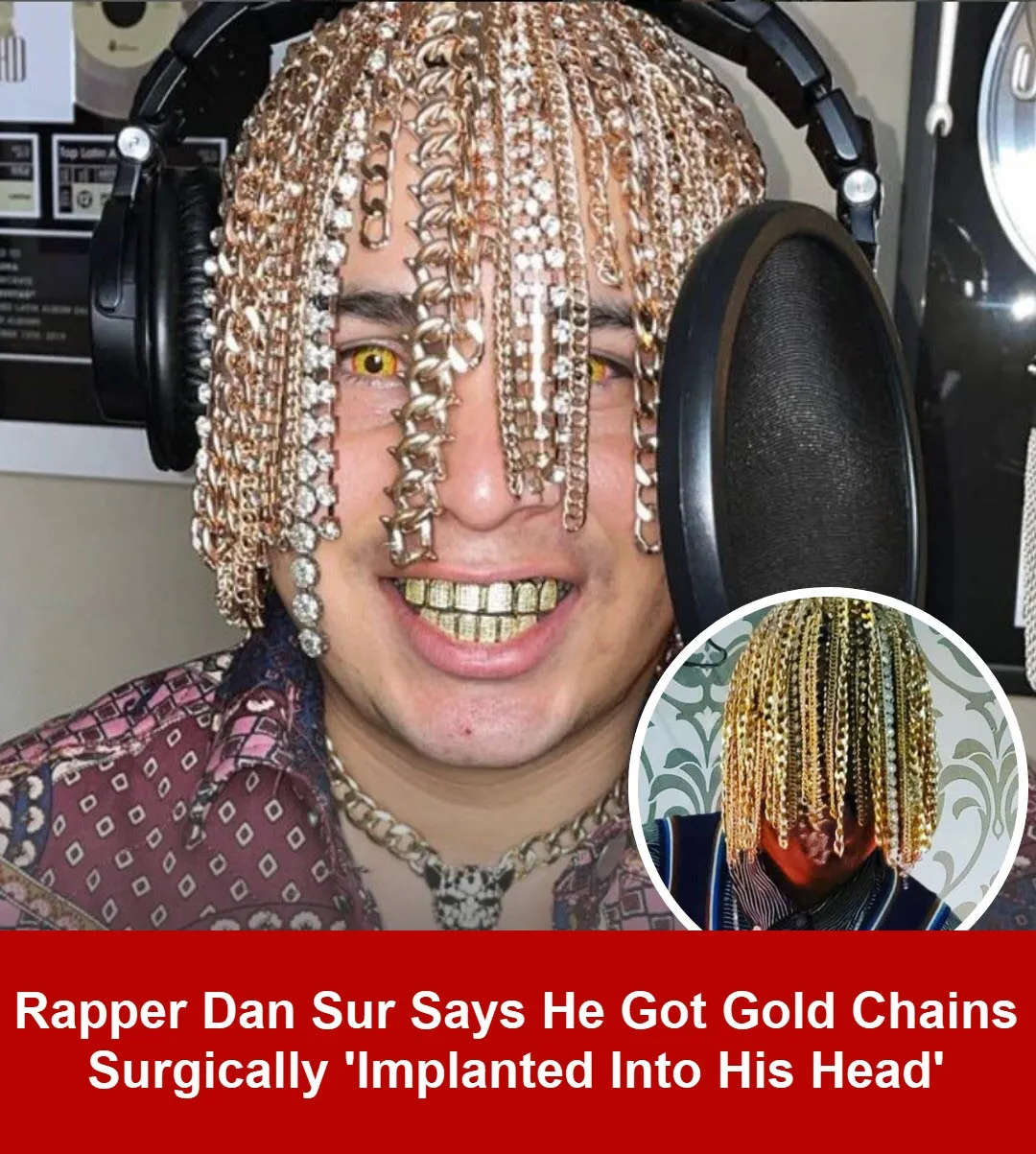 9. Rapper had surgery to get gold chains implanted into his skull