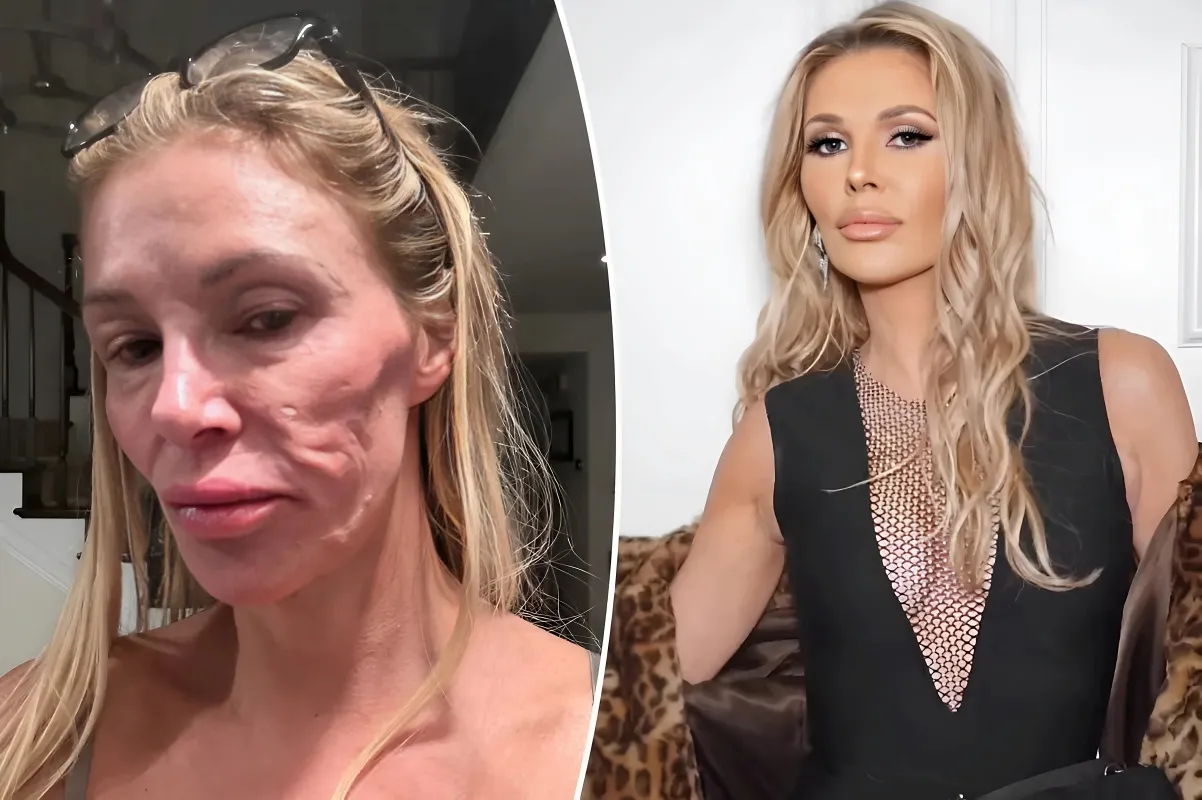 Brandi Glanville Reveals Shocking Diagnosis: Doctors Suggest Facial Disfigurement Linked to a 'Jumping' Parasite - lulu