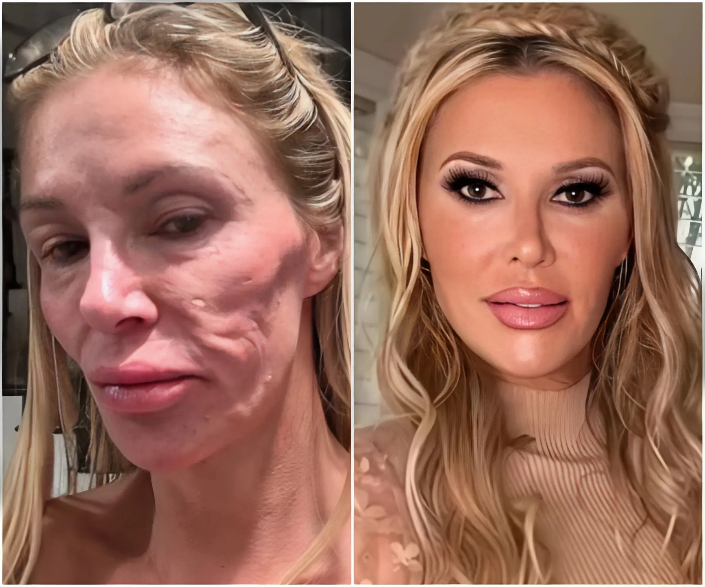 Brandi Glanville reveals doctor's shock theory about the REAL reason her face is now unrecognizable - suong