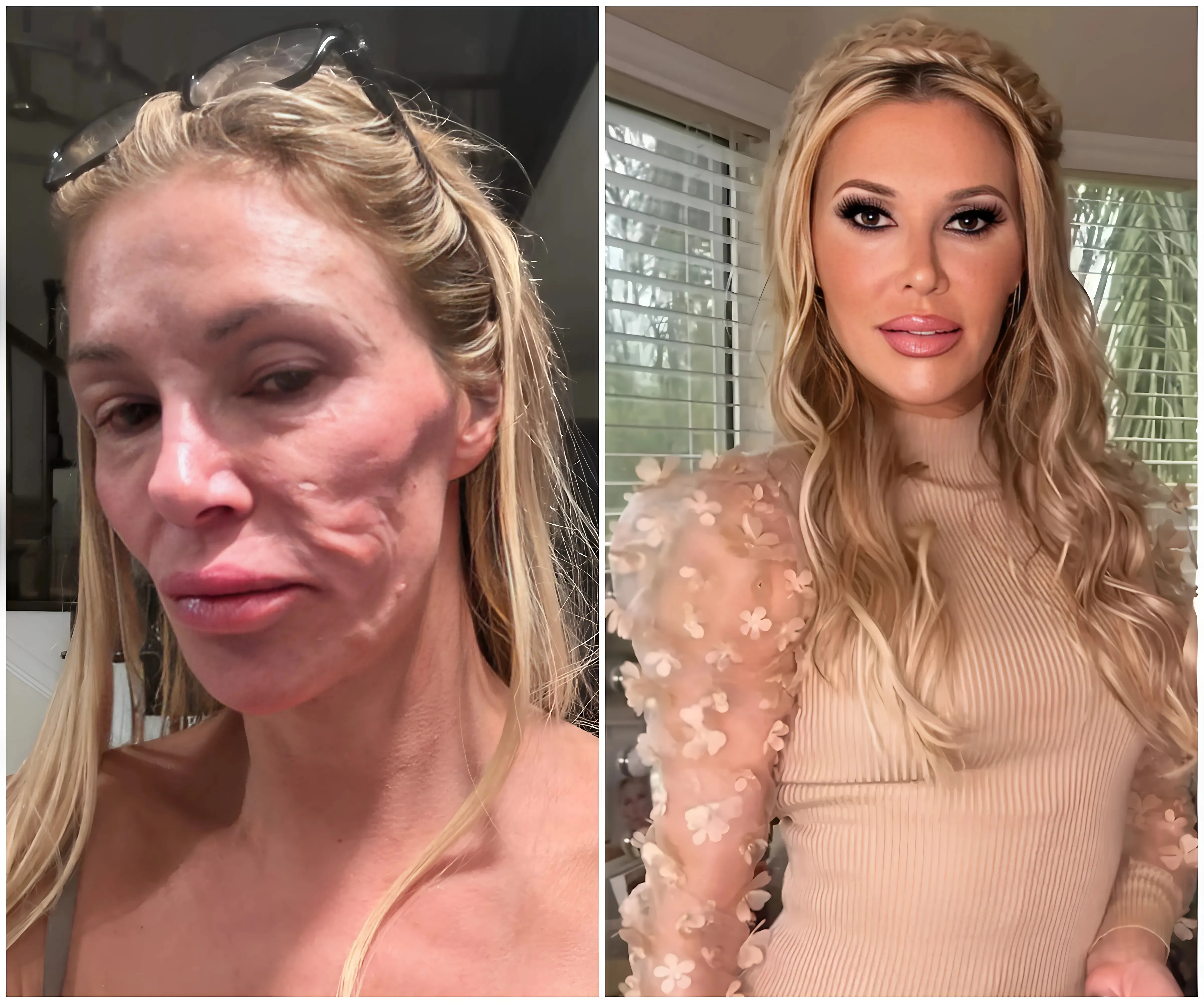 Brandy Glanville’s Doctors Say There’s A “Parasite That Jumps Around” Her Face … She Blames “Bravo”