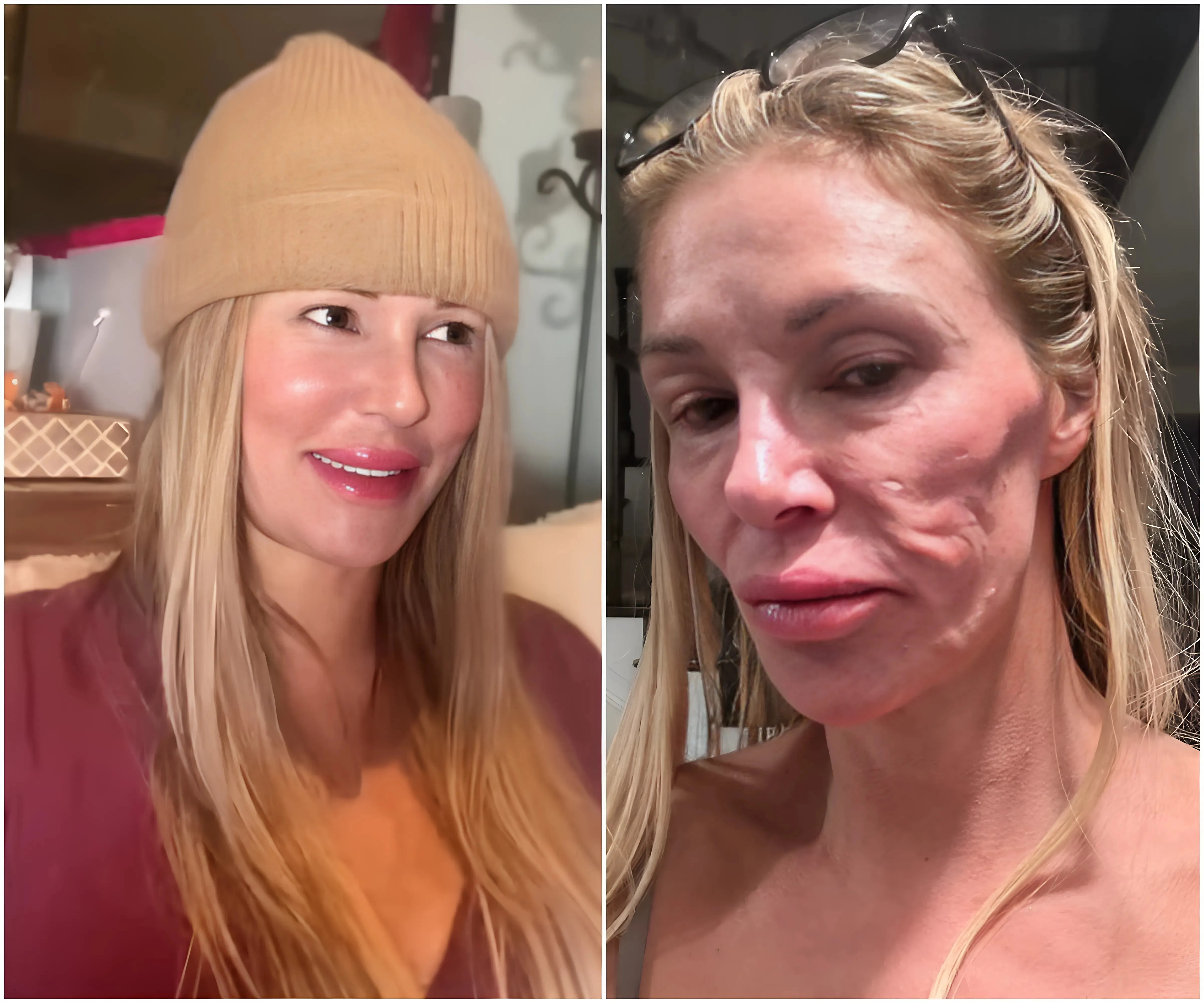 Brandi Glanville, 52, displays markedly smoother and taut appearance as expert gets to the bottom of skin disfiguration - after reality star claimed her swollen face was caused by 'a parasite' and 'stress' - suong