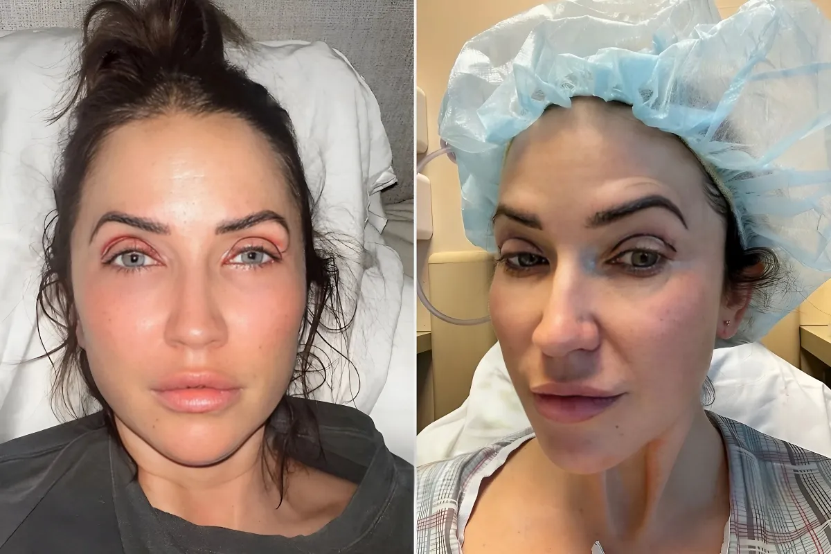 Kaitlyn Bristowe Shares Raw Post-Op Photos from Eyelid Surgery: 'Everyone Wants to Look Like This'