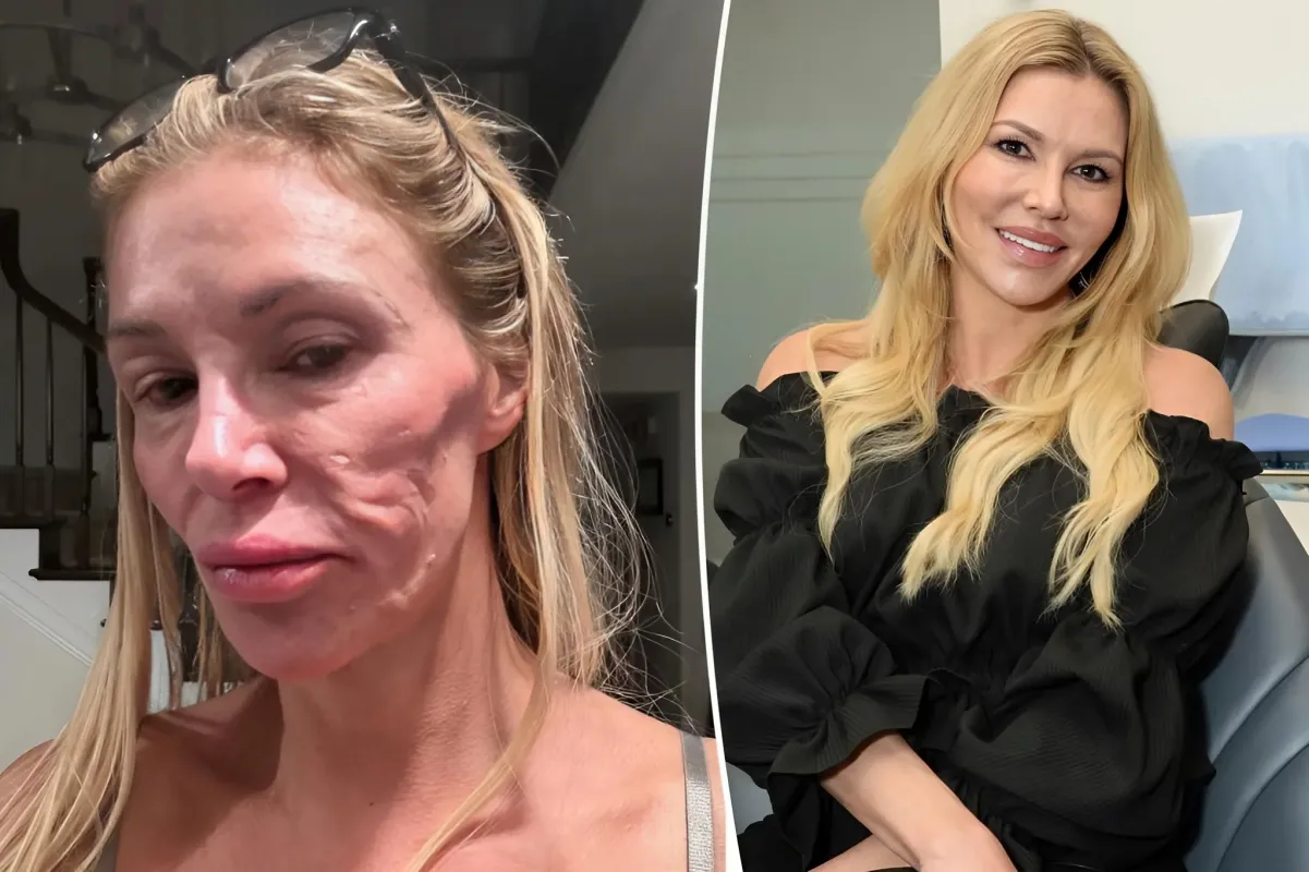 Brandi Glanville has spent over $70K trying to figure out the cause of her facial disfigurement