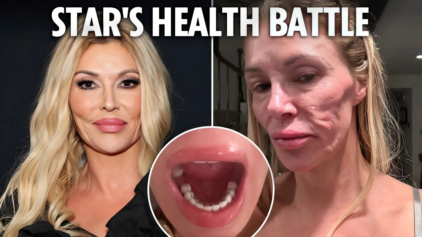 Brandi Glanville's Struggle: Losing 5 Teeth Amidst Battle with Facial Disfigurement - lulu