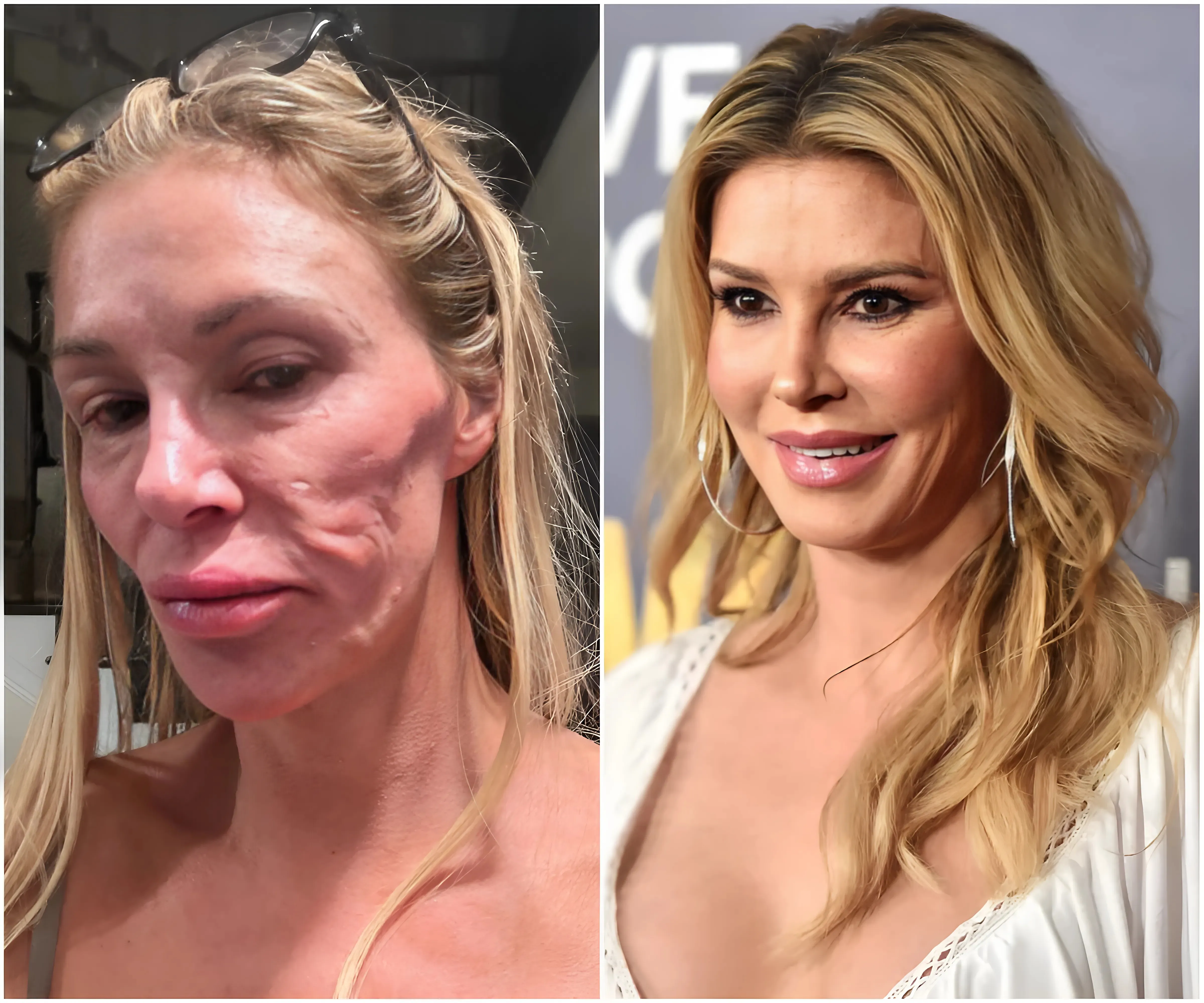 Brandi Glanville Says She’s Spent $70K Trying Cure Herself of Face Parasites