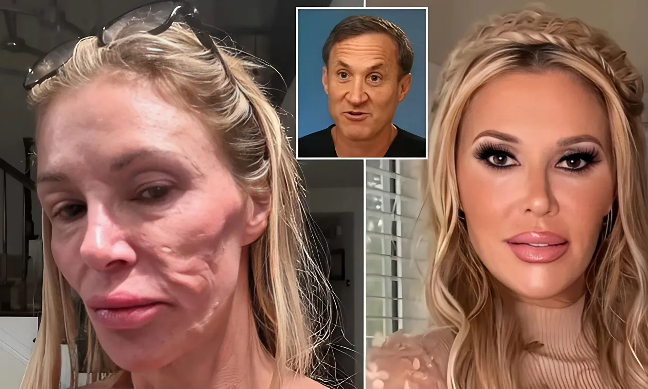 Botched Surgeon's Urgent Alert to Brandi Glanville: Unveiling a New Theory on Her 'Parasite' Face - lulu