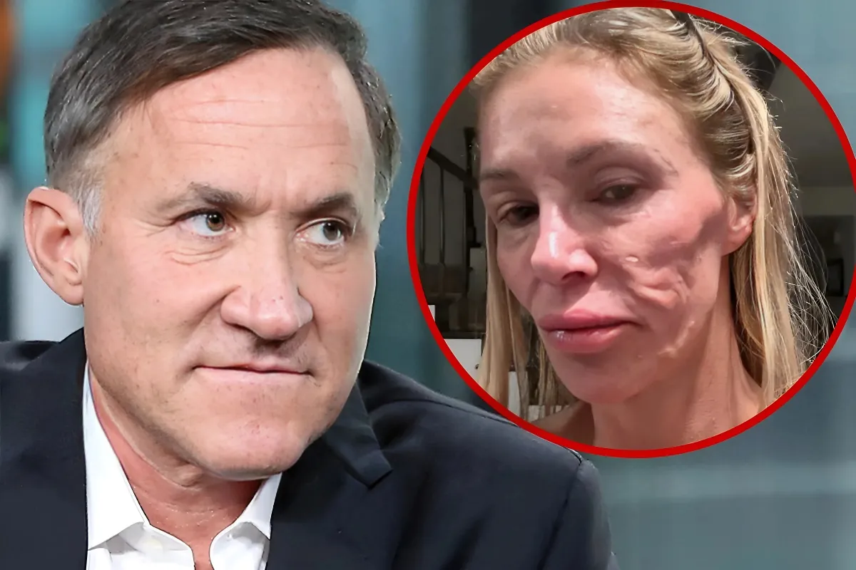 Dr. Terry Dubrow Explains Brandi Glanville's Face Isn't Because of Parasite