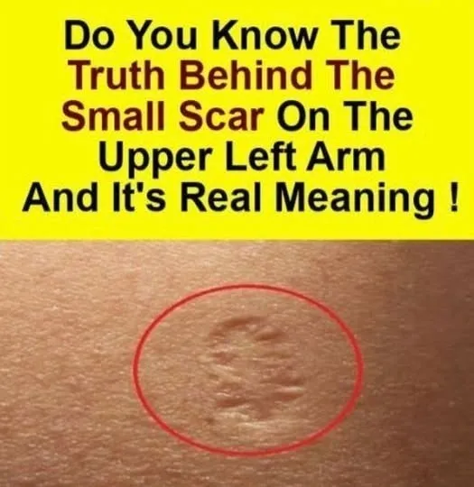 5. Smallpox vaccine scars: What they look like and why s2