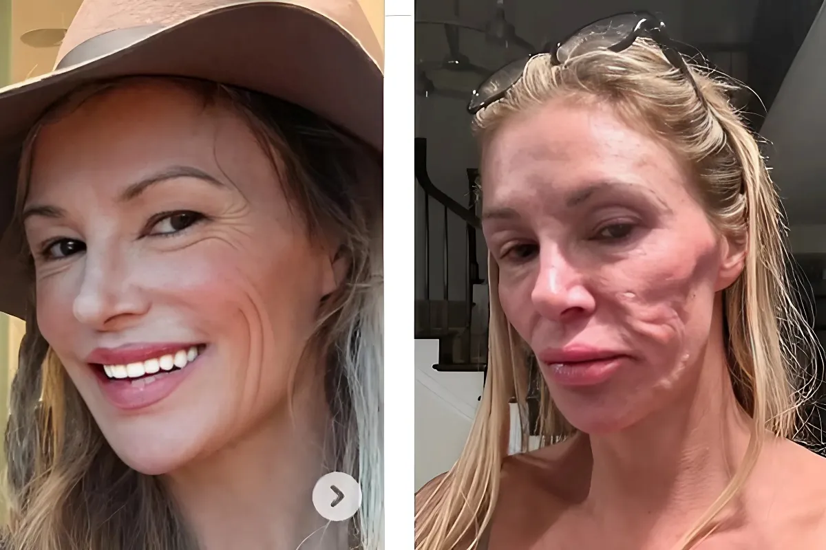 Brandi Glanville, 52, Unveils Striking Transformation: Fans Stunned by Remarkably Tightened Appearance in Recent Health Update Following Disfiguring 'Parasite' Encounter - lulu