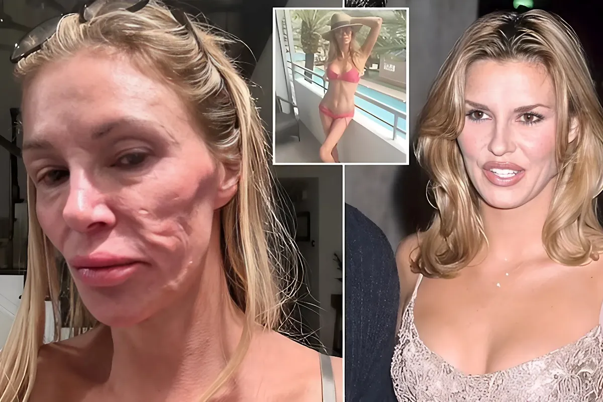 Brandi Glanville, 52, Contemplates Plastic Surgery to Restore Appearance Following 'Parasite' Facial Dilemma - lulu