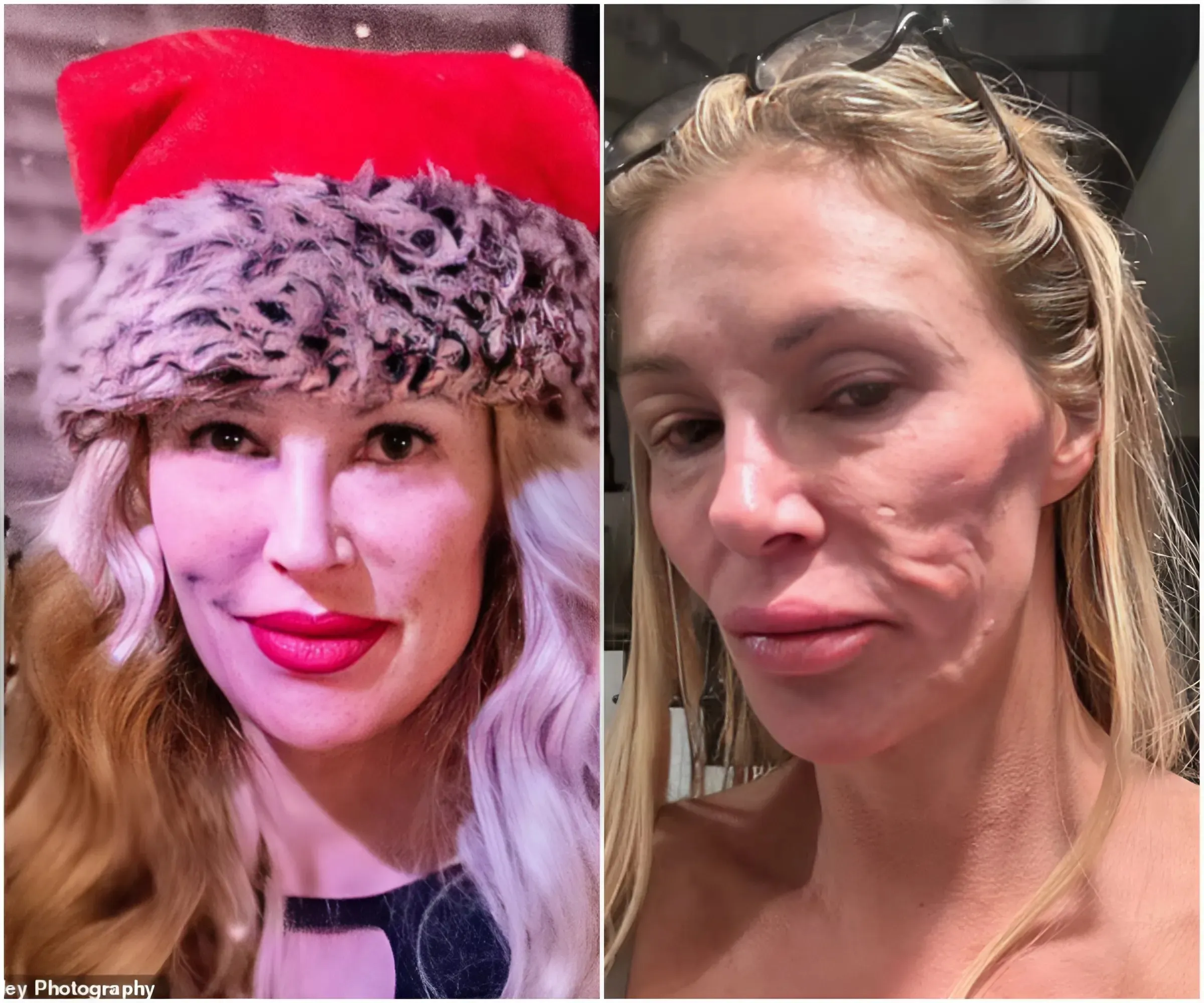 Brandi Glanville shows her face in public for first time after having her facial fillers dissolved - suong