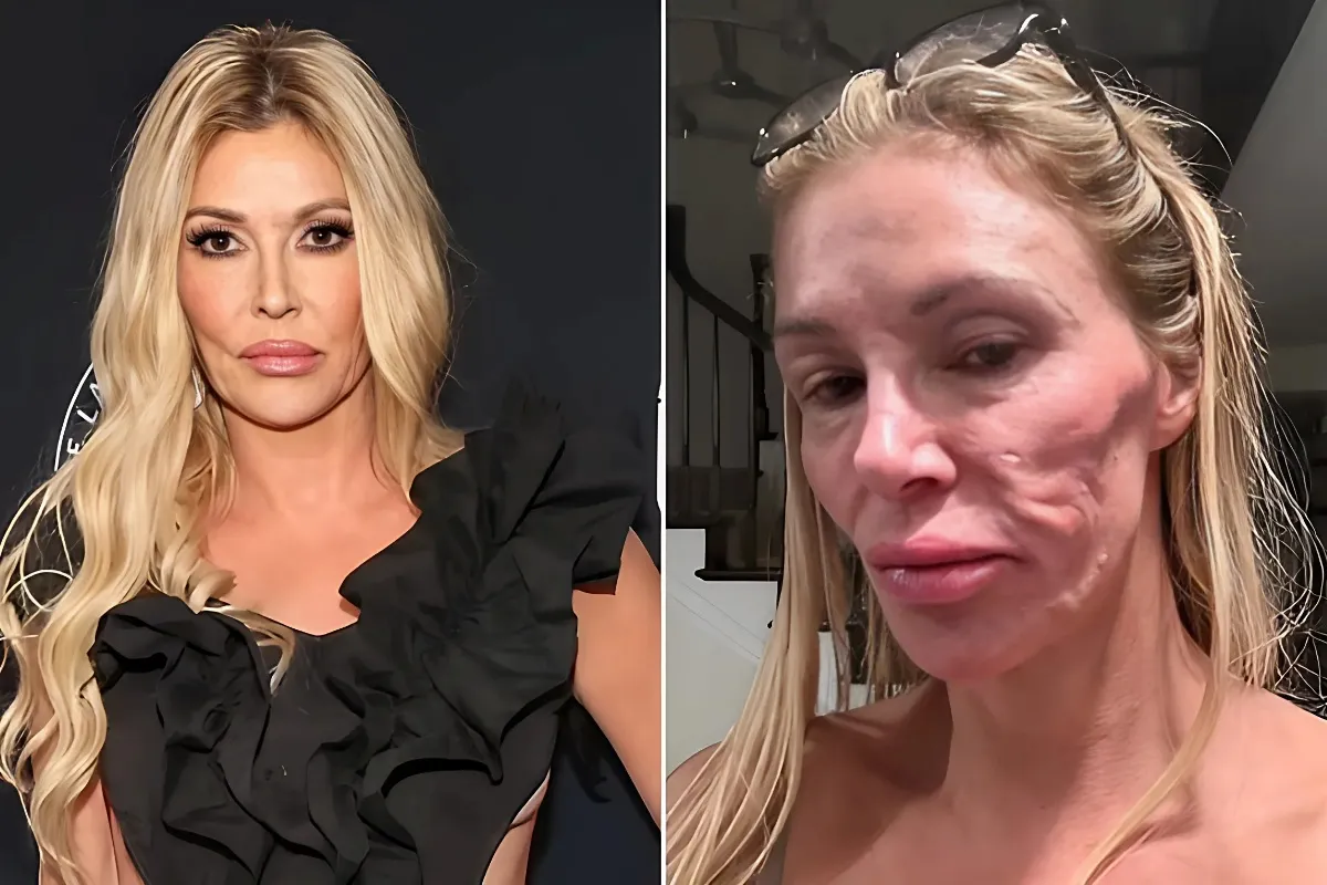 Brandi Glanville talks about being 'deeply depressed' while battling facial disfigurement: 'I looked like a drug addict' - lulu