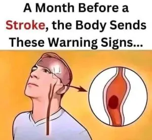 F. A Month Before a Stroke: Know the Warning Signs