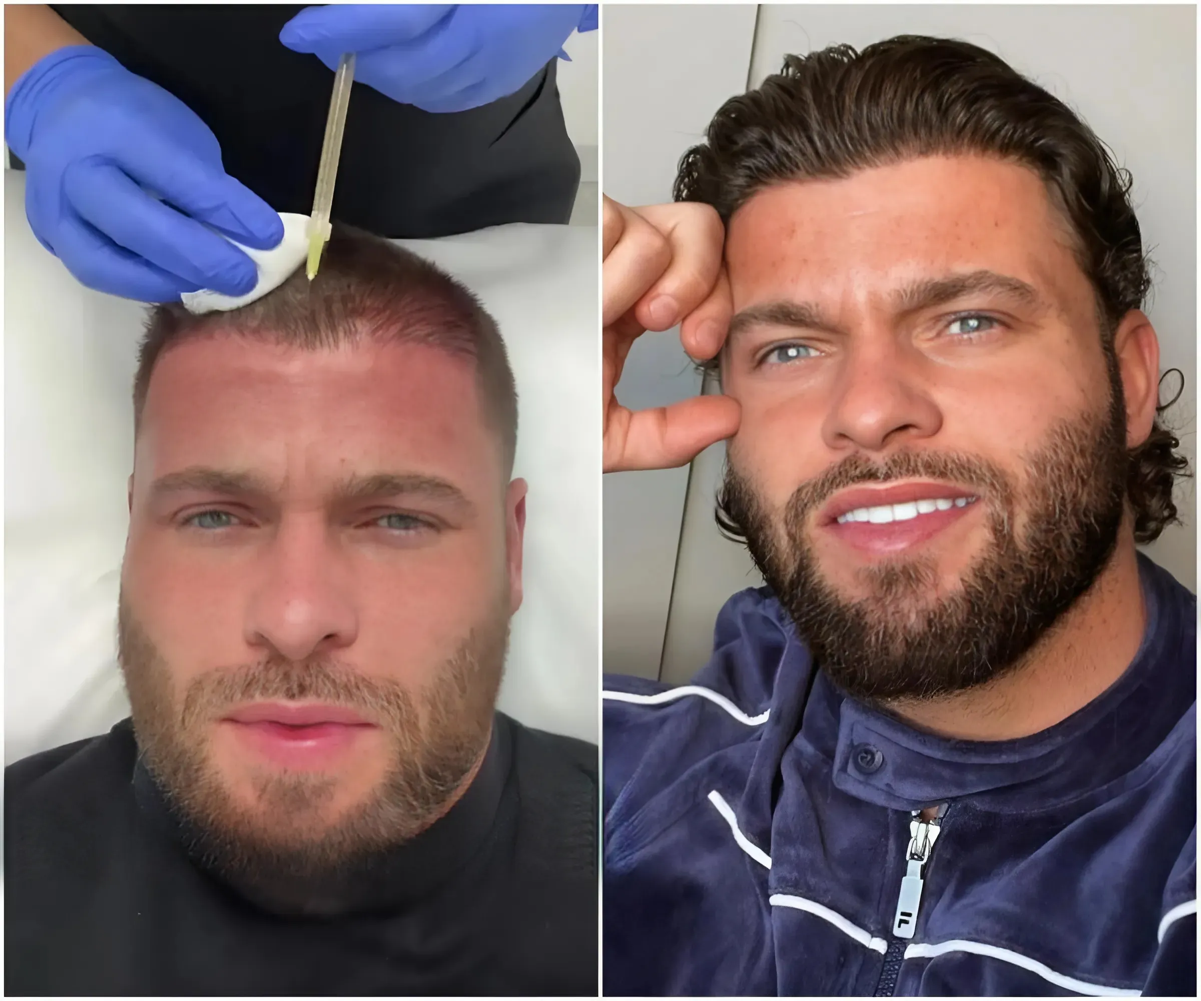 Love Island star gets painful £500 injections in his head in bid to stop hair loss a year after £4k transplant - suong