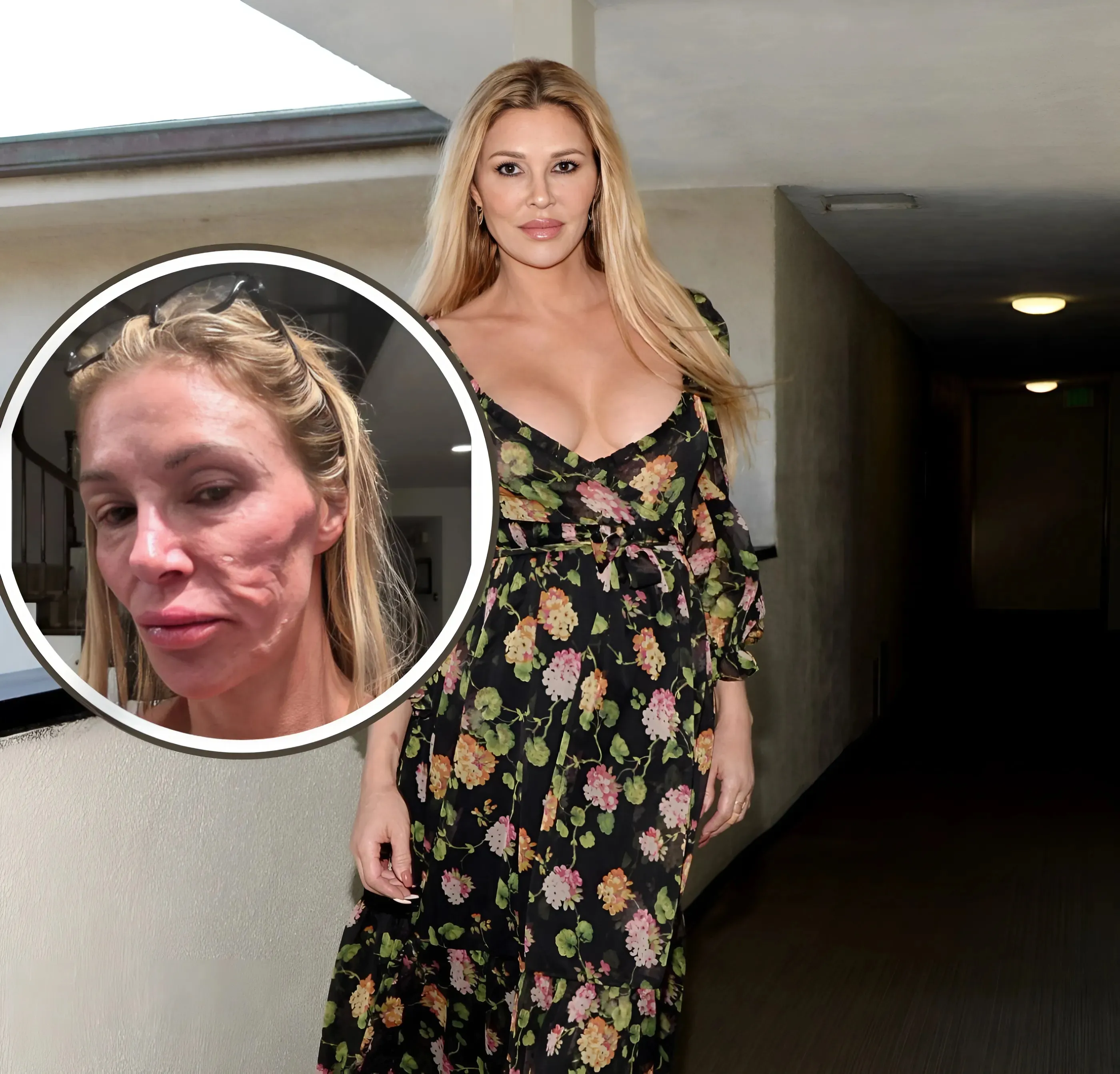 Brandi Glanville Offers Update on Face Amid Health Crisis as She Compares Herself to a “Crackhead” & Admits to Bouts of Depression