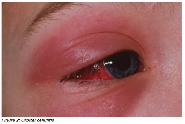 9.. Diagnosis and management of common eyelid conditions