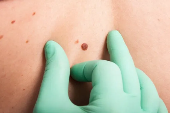 9.. Skin Cancer And Everything You Need To Know