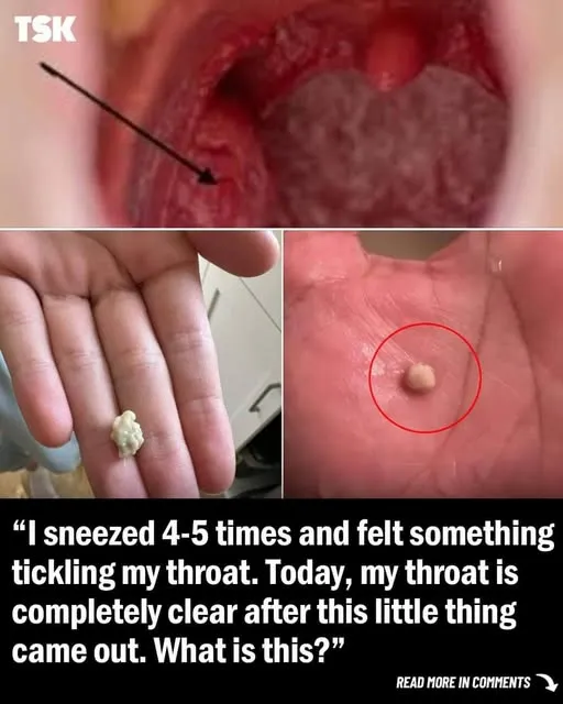 Here is what you need to know about tonsil stones – the weird pimple-like growths in your throat