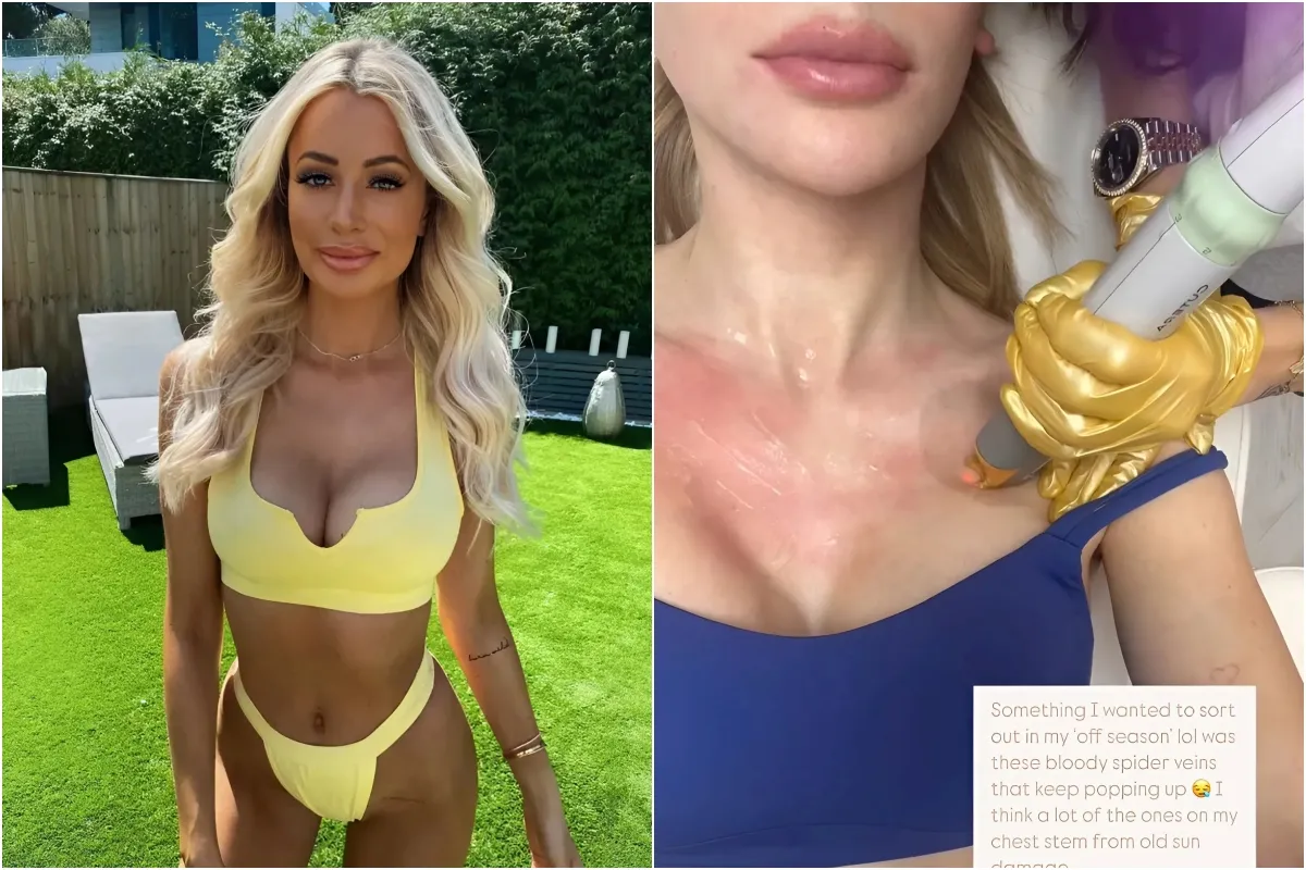 Olivia Attwood admits hiding her face after nips and tucks leave her looking like an ‘alien’ ngocc