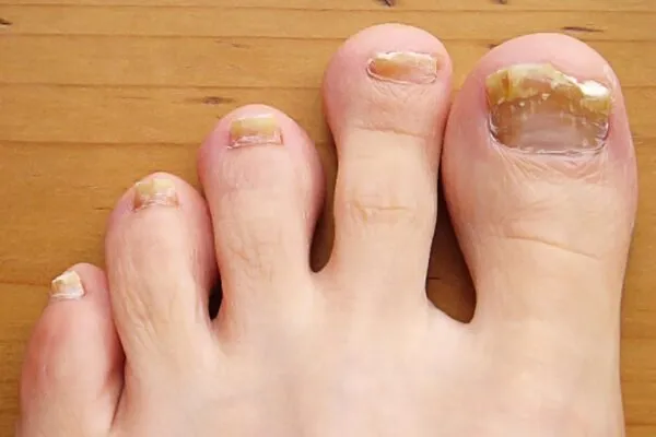 5. Causes and treatments for thick toenails