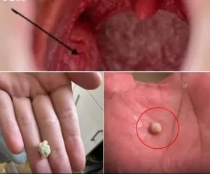 P1. The Surprising Truth About Tonsil Stones: What They Are, Why They Form, and How to Remove Them