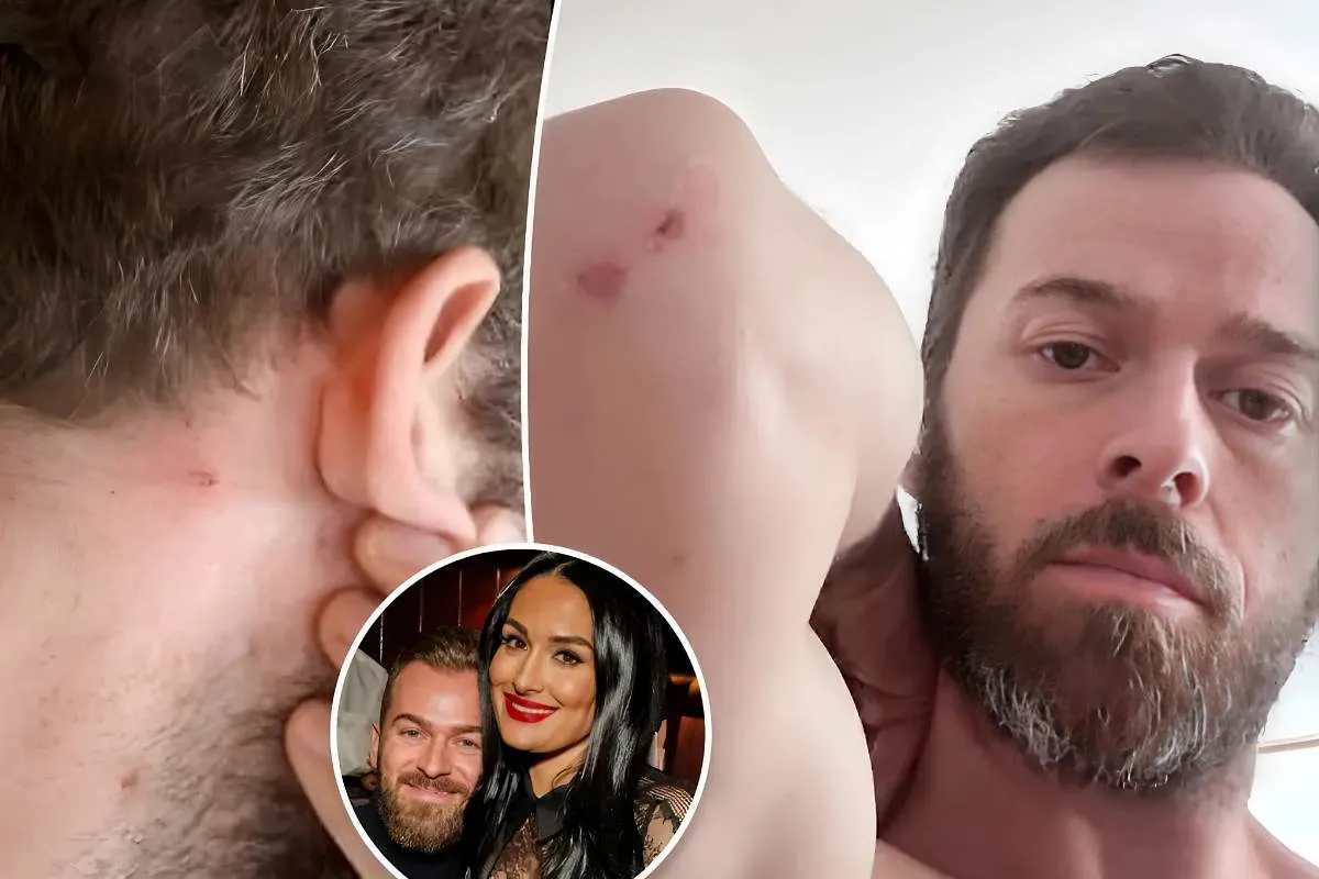 Artem Chigvintsev Reveals Shocking Allegations: Claims Nikki Garcia Was the Aggressor, Displays Bloody Scratches on Arms and Neck tram