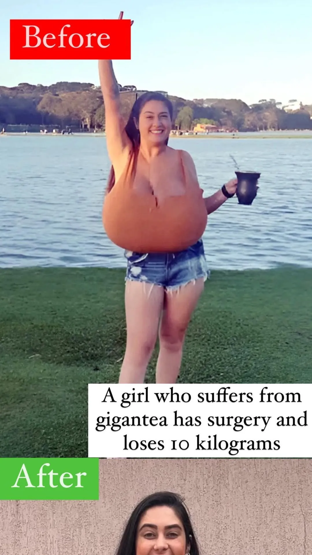 5.. This is the day’s positive story: a girl who suffers from gigantea has surgery and loses 10 kilograms (22 pounds)… 5.. This is the day’s positive story: a girl who suffers from gigantea has surgery and loses 10 kilograms (22 pounds)…