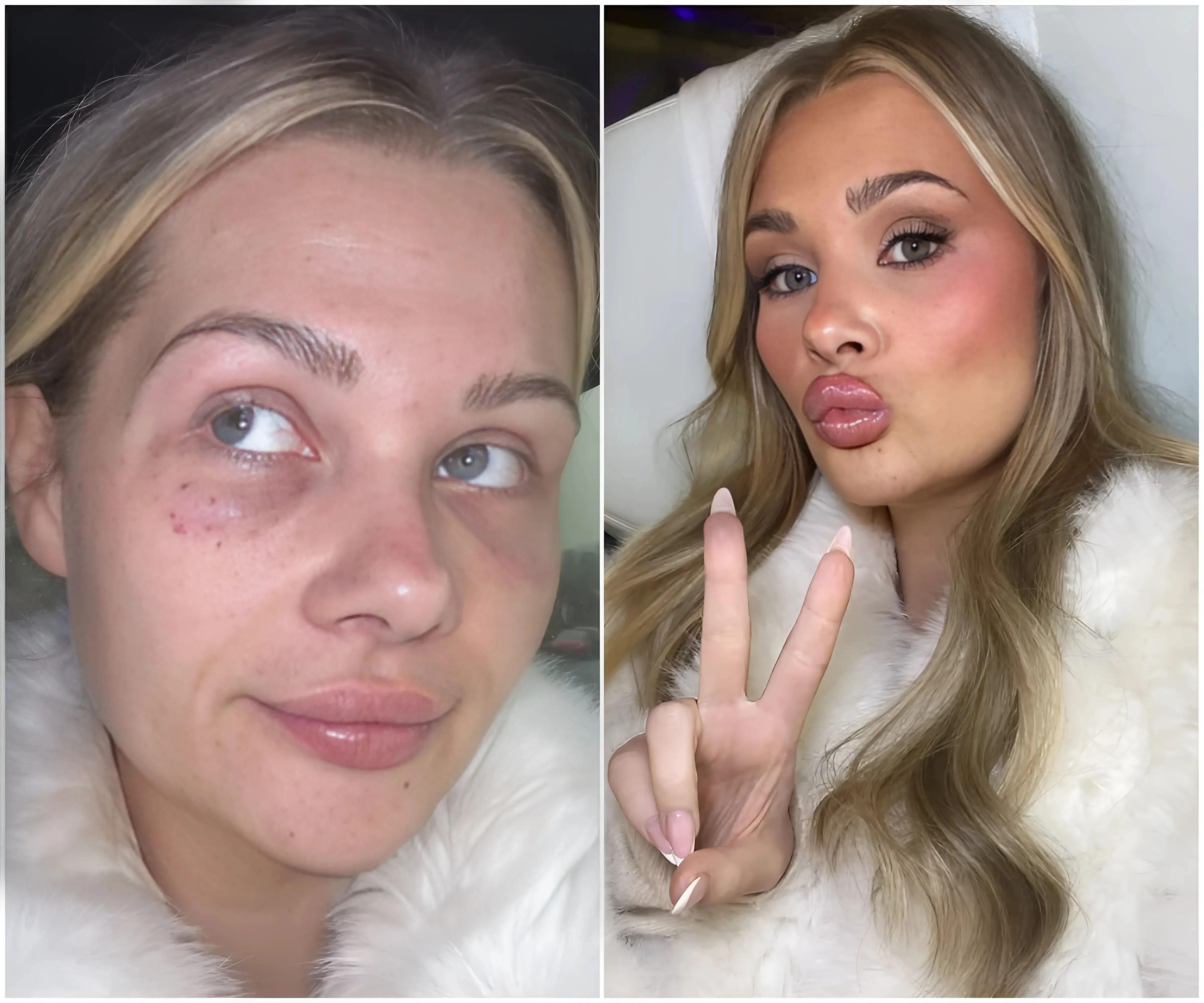 Love Island’s Shaughna Phillips sparks concerns as she reveals very bruised face after latest treatment - suong