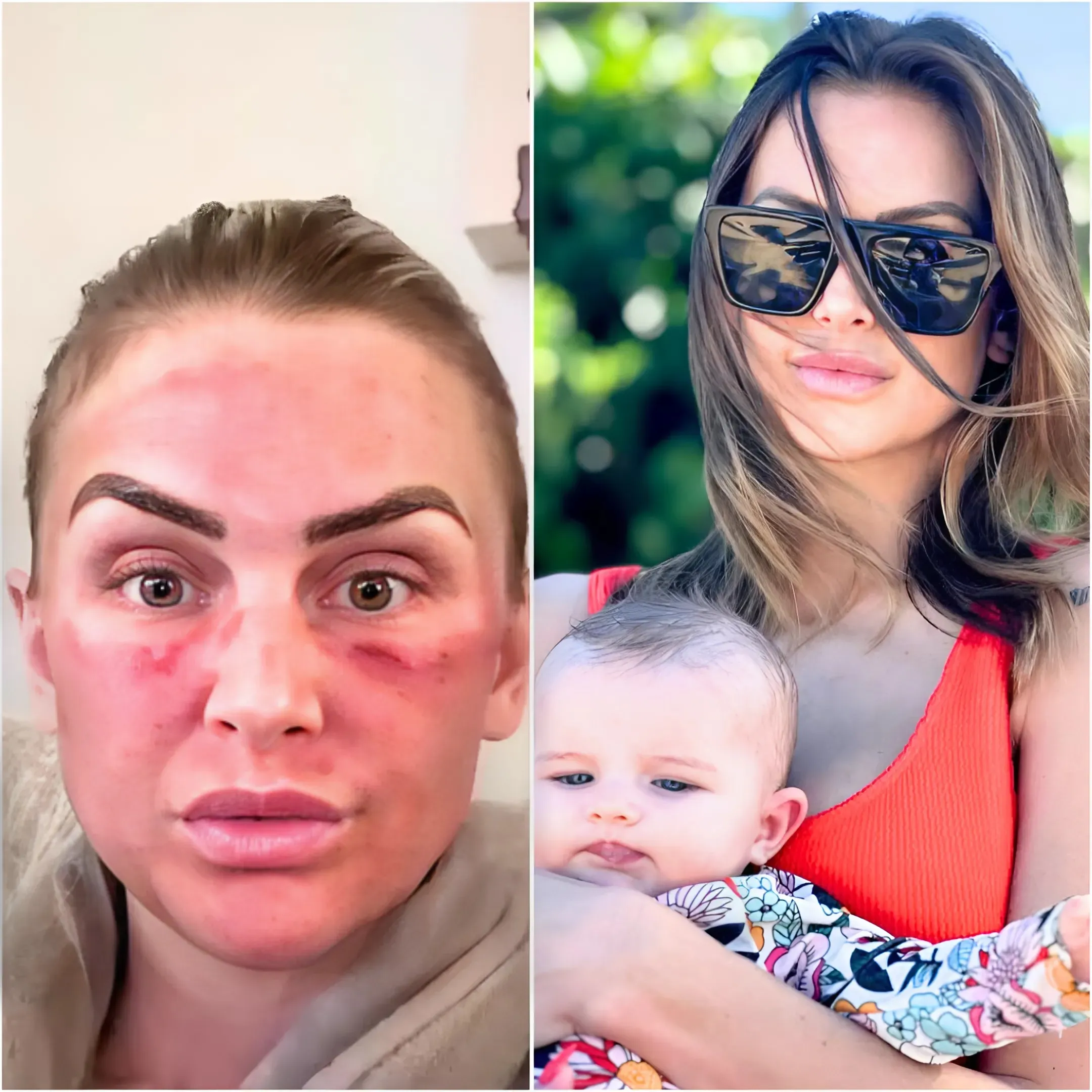 Lala Kent shows off her bruised face after undergoing beauty procedure