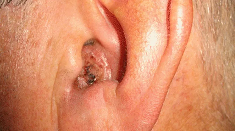 9.. Ear Tumors: Recognizing Symptoms, Understanding Types & Exploring Treatment Options