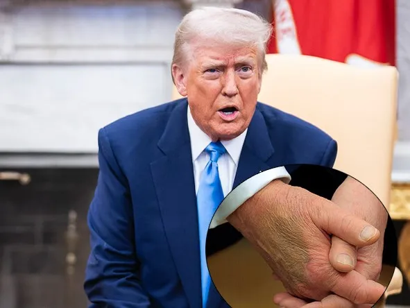 5. White House responds after Donald Trump sports nasty bruise