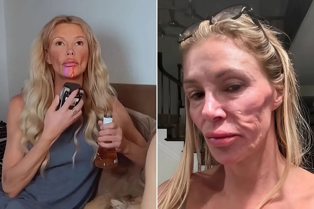 Brandi Glanville uses red light device on her face amid her disfiguring skin condition woes